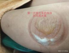 群里美女足三里拔罐排毒记录