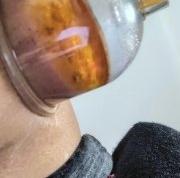 股骨头积液拔罐案例