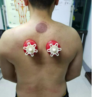 萨满48穴取穴点。萨满罐取穴方法参考。