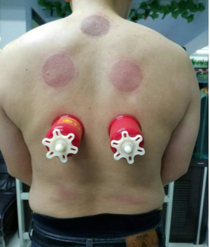 萨满48穴取穴点。萨满罐取穴方法参考。