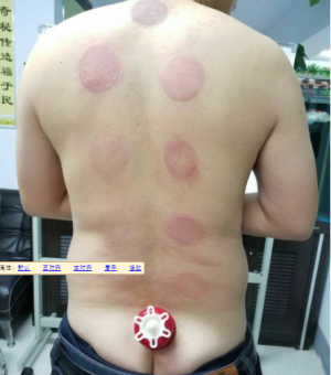 萨满48穴取穴点。萨满罐取穴方法参考。