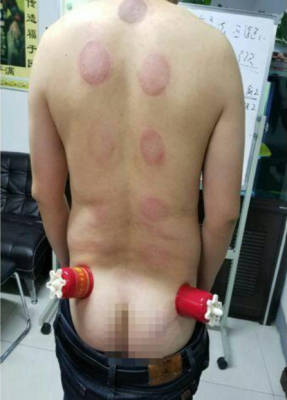 萨满48穴取穴点。萨满罐取穴方法参考。