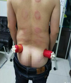 萨满48穴取穴点。萨满罐取穴方法参考。