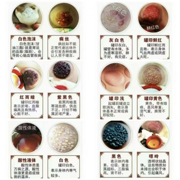 罐印和体液分析